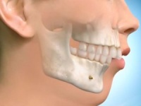Методика коррекции ретрогнатии и ретрогении челюстей