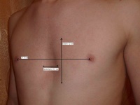 Лечение воронкообразной деформации грудной клетки