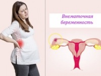 Внематочная беременность на ранних сроках