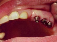 Зубные имплантаты с установкой