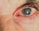 Глаукома – грозная глазная болезнь