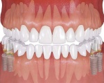 Имплантаты — третьи зубы человека